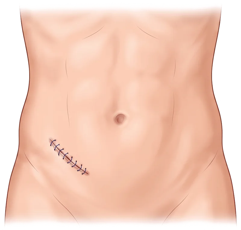 Diagrama de la incisión única en la parte baja derecha del abdomen, típica de una apendicectomía abierta