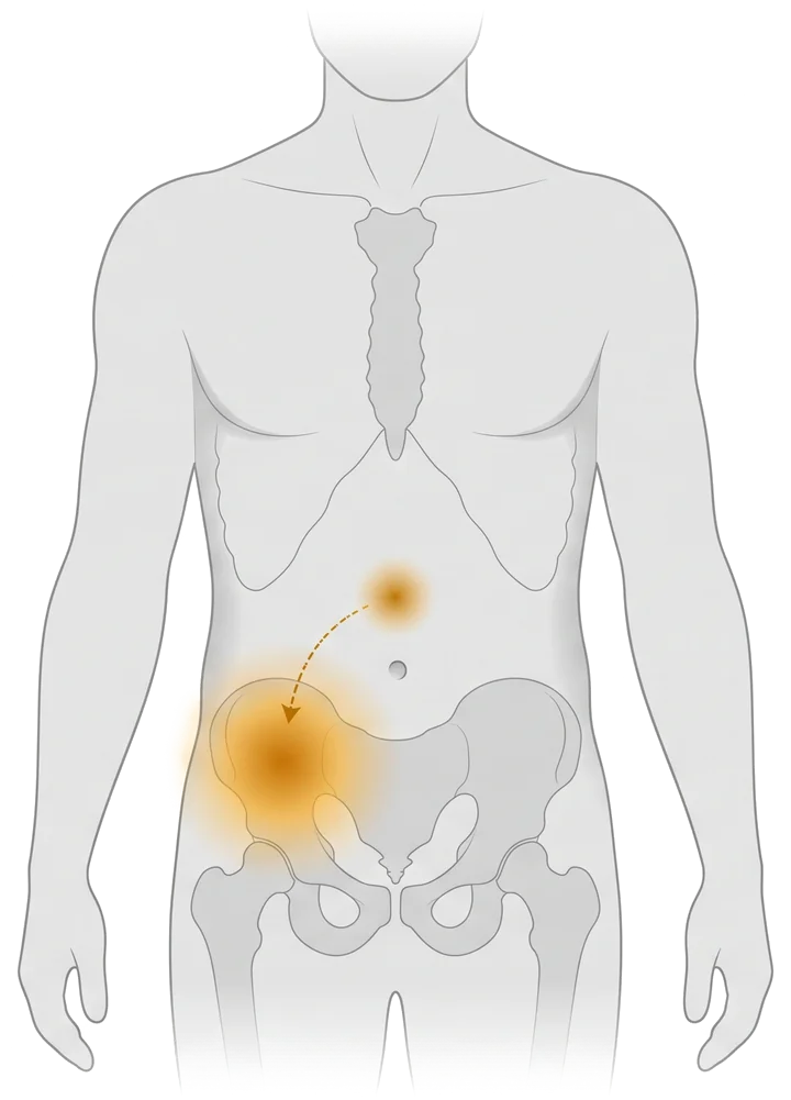 Diagrama del dolor migratorio de la apendicitis: inicia cerca del ombligo y se desplaza hacia la parte baja derecha del abdomen