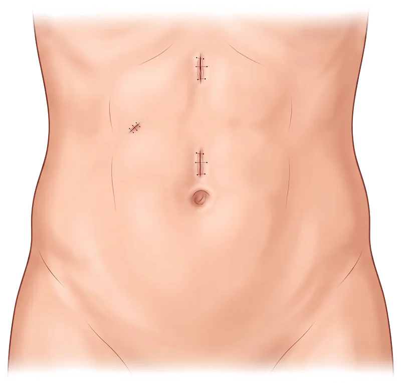 Diagrama de las pequeñas incisiones típicas de una colecistectomía laparoscópica en la parte superior derecha del abdomen