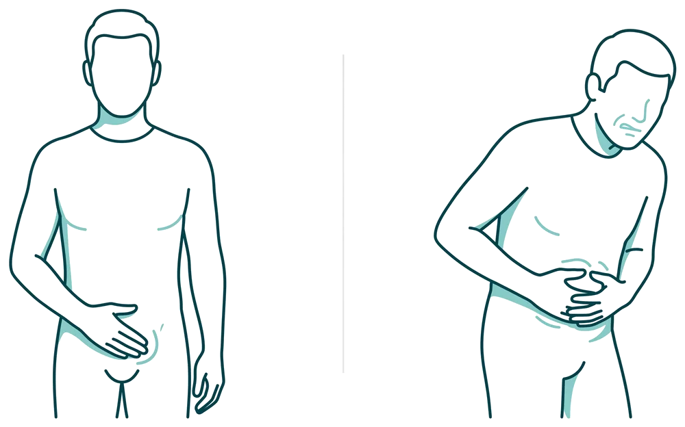 Ilustración comparativa entre una hernia reducible y una hernia atorada o estrangulada