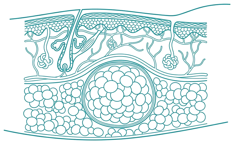 Diagrama en corte transversal de la piel mostrando un lipoma: una acumulación de tejido graso encapsulado justo debajo de la piel
