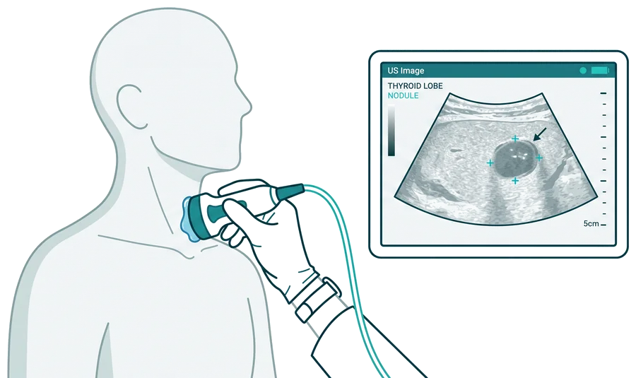 Diagrama de la evaluación de un nódulo tiroideo con ultrasonido y biopsia por punción guiada