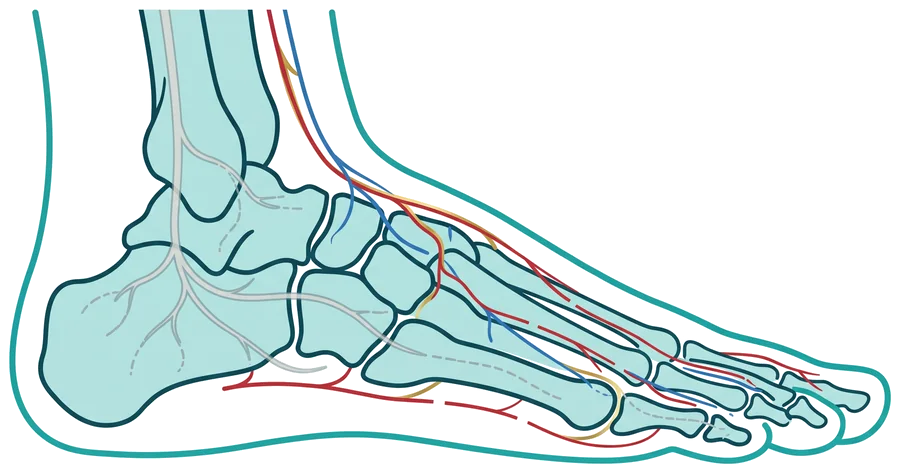 Diagrama del pie mostrando nervios dañados por neuropatía y vasos sanguíneos con circulación reducida