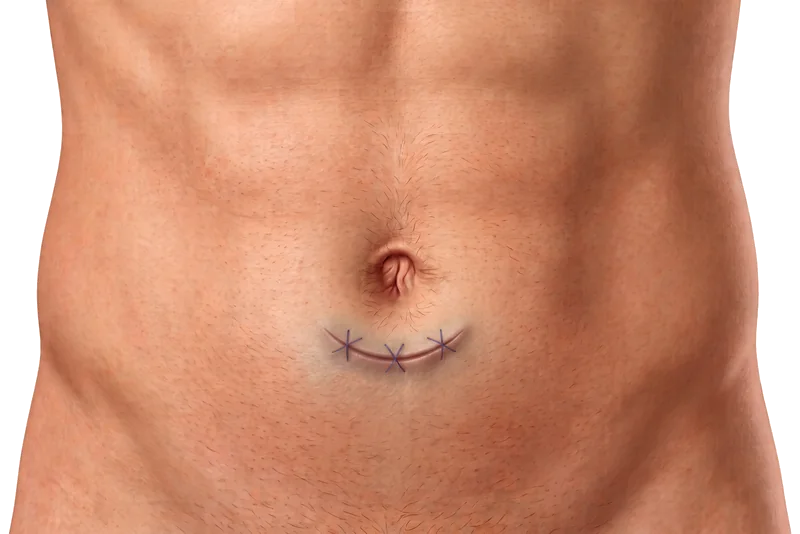 Diagrama de la incisión pequeña junto al ombligo, típica de una plastia umbilical abierta