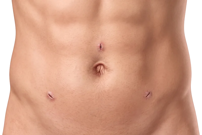 Diagrama de las pequeñas incisiones típicas de una plastia umbilical laparoscópica